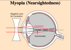 How to Handle Night Blindness and Headlight Glare - HealthProAdvice