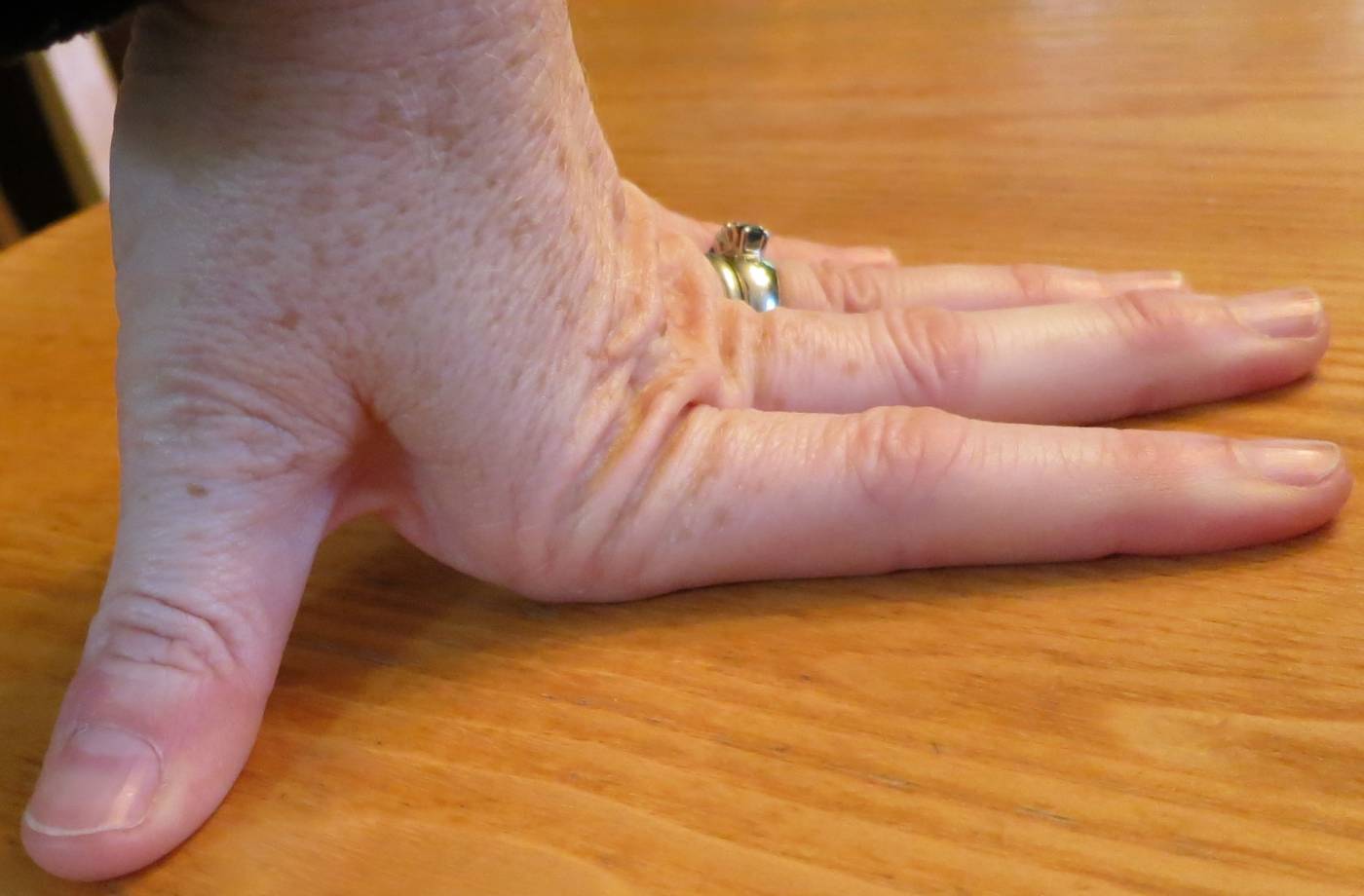 What Is EhlersDanlos Syndrome? My Story Patient's Lounge