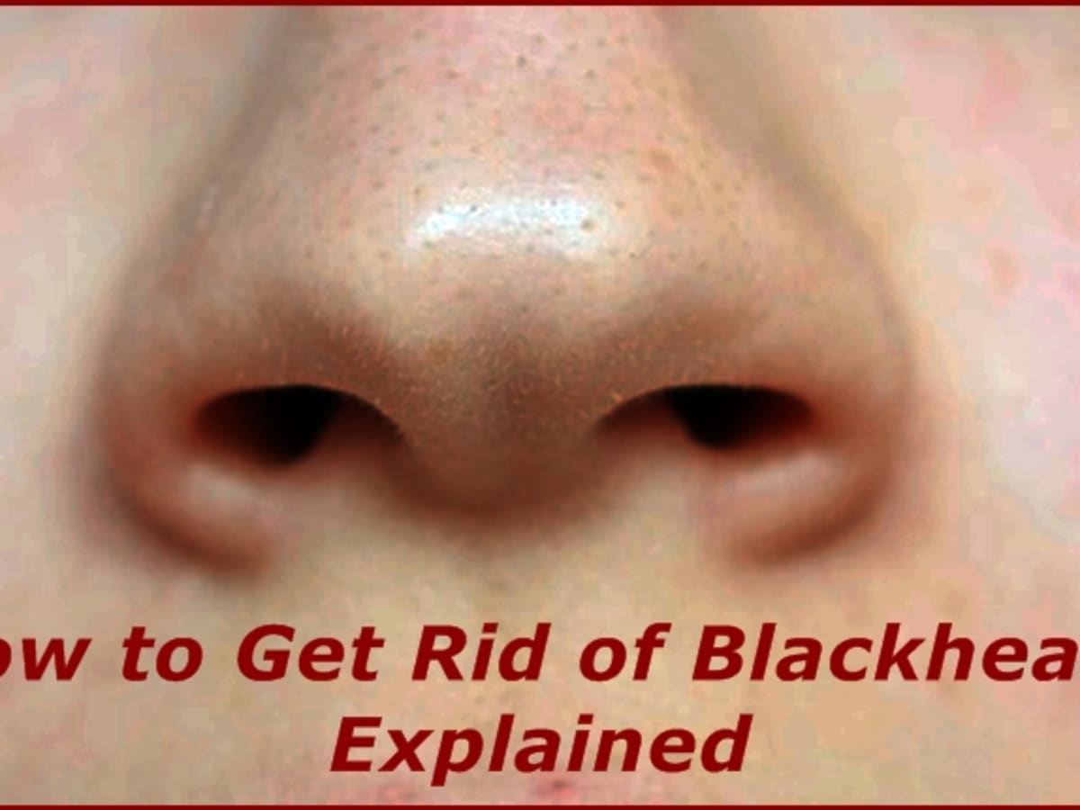 How to remove blackheads