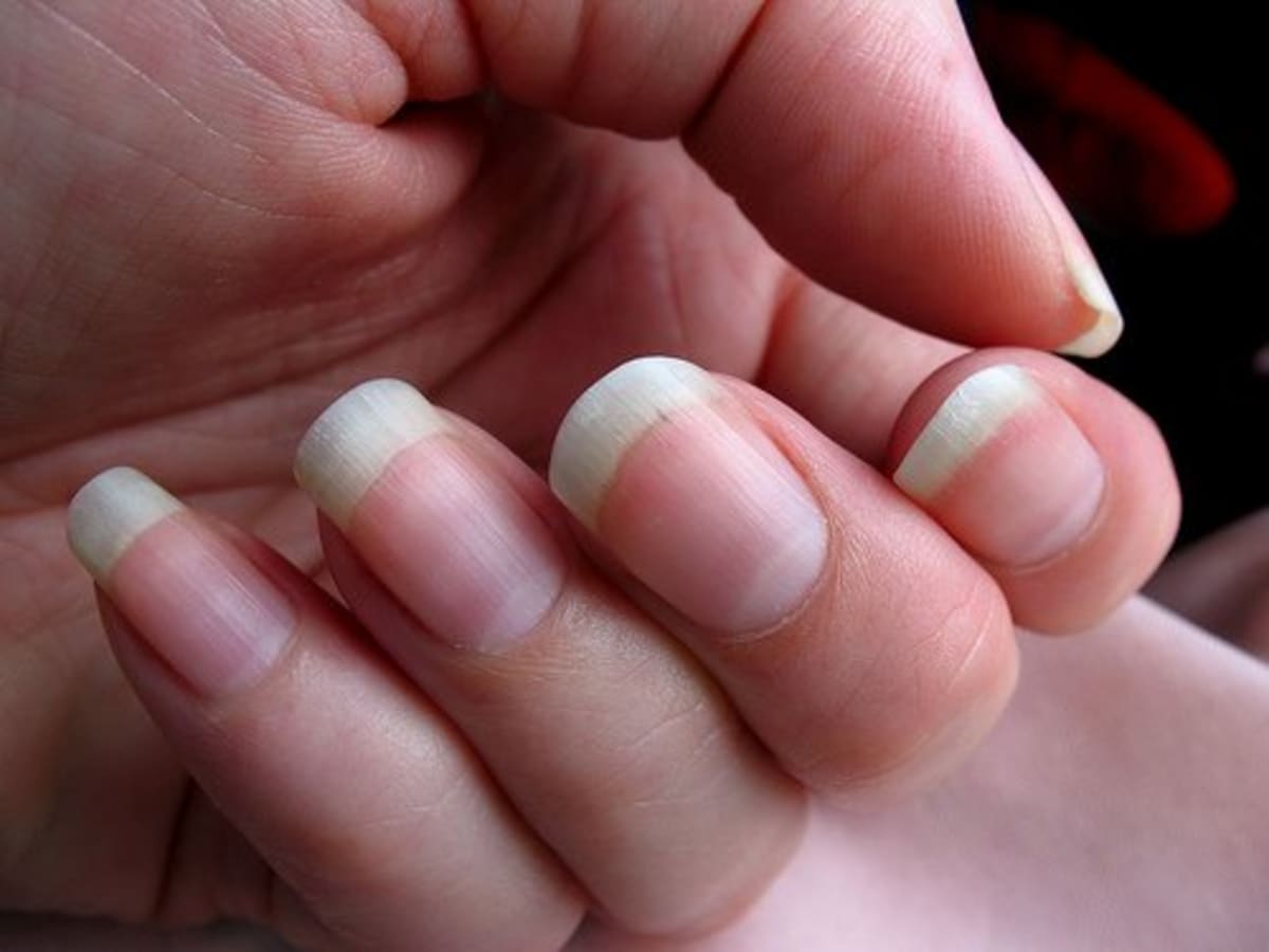 Why People Bite Their Nails and How to Stop - HubPages