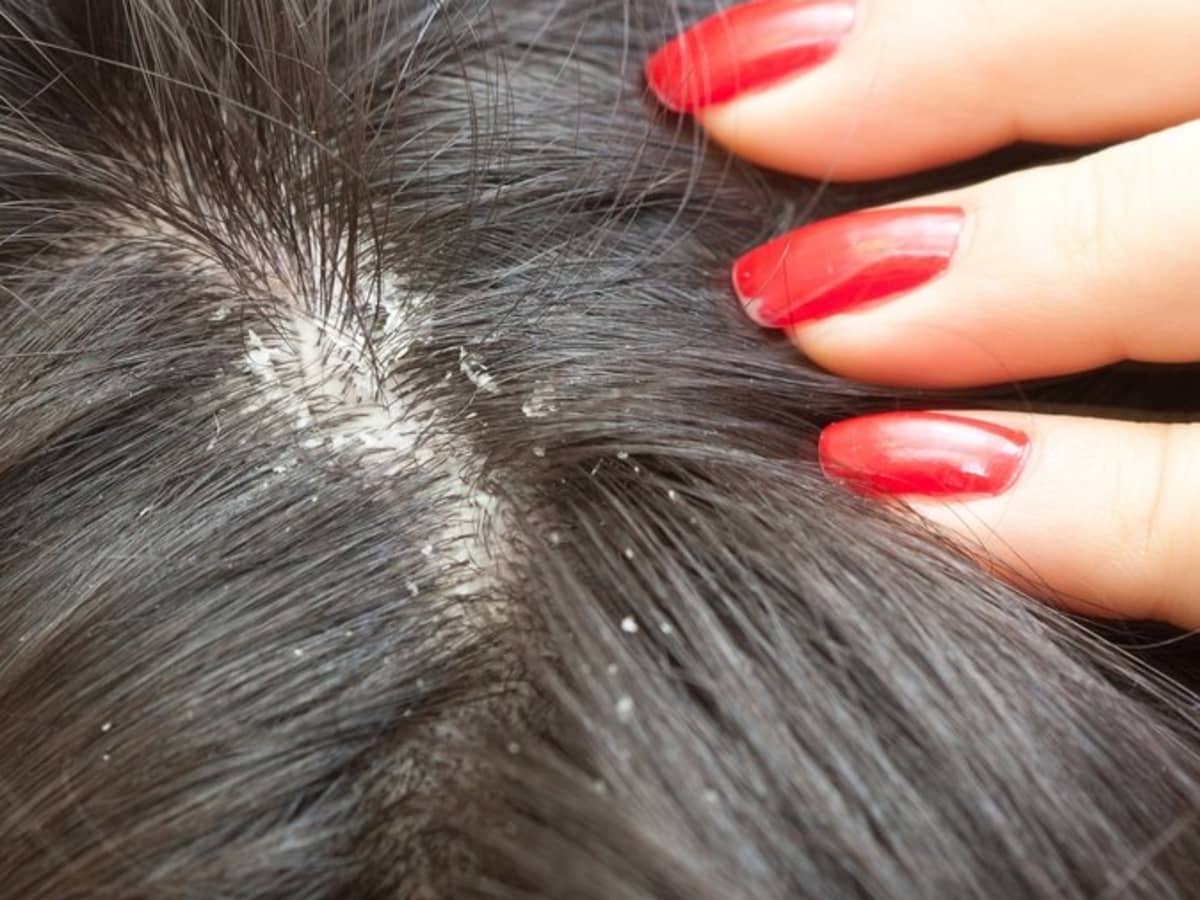 Home Cures for Dry, Flaky Scalp - Bellatory