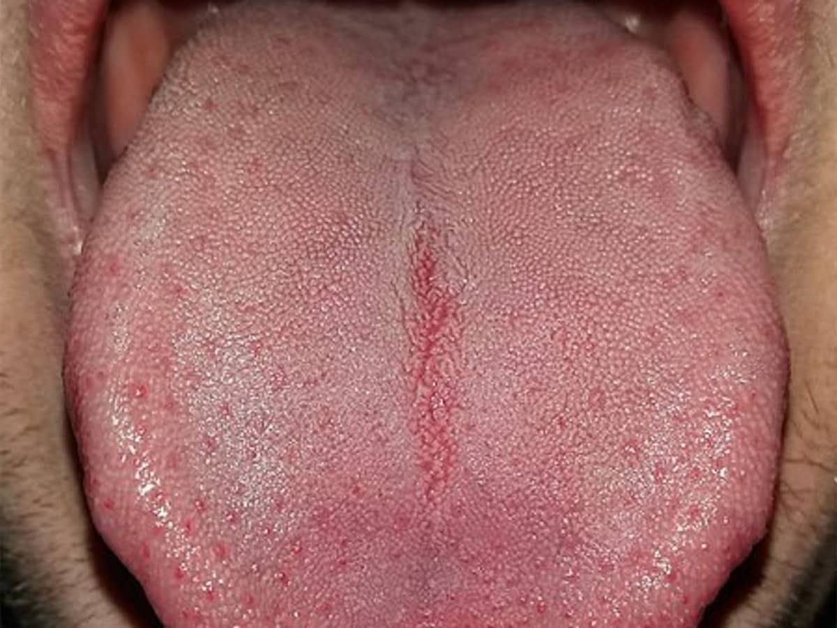 healthy tongue pictures vs unhealthy