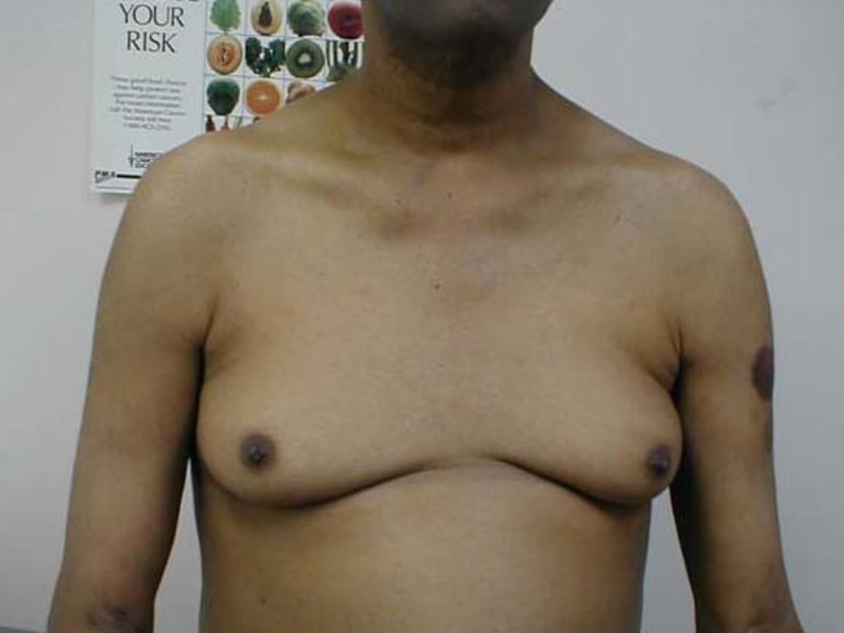 Why some men grow big breasts - The Standard Health