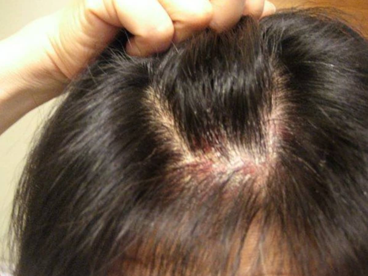 Scalp Psoriasis Symptoms Plaque Causes  Treatment