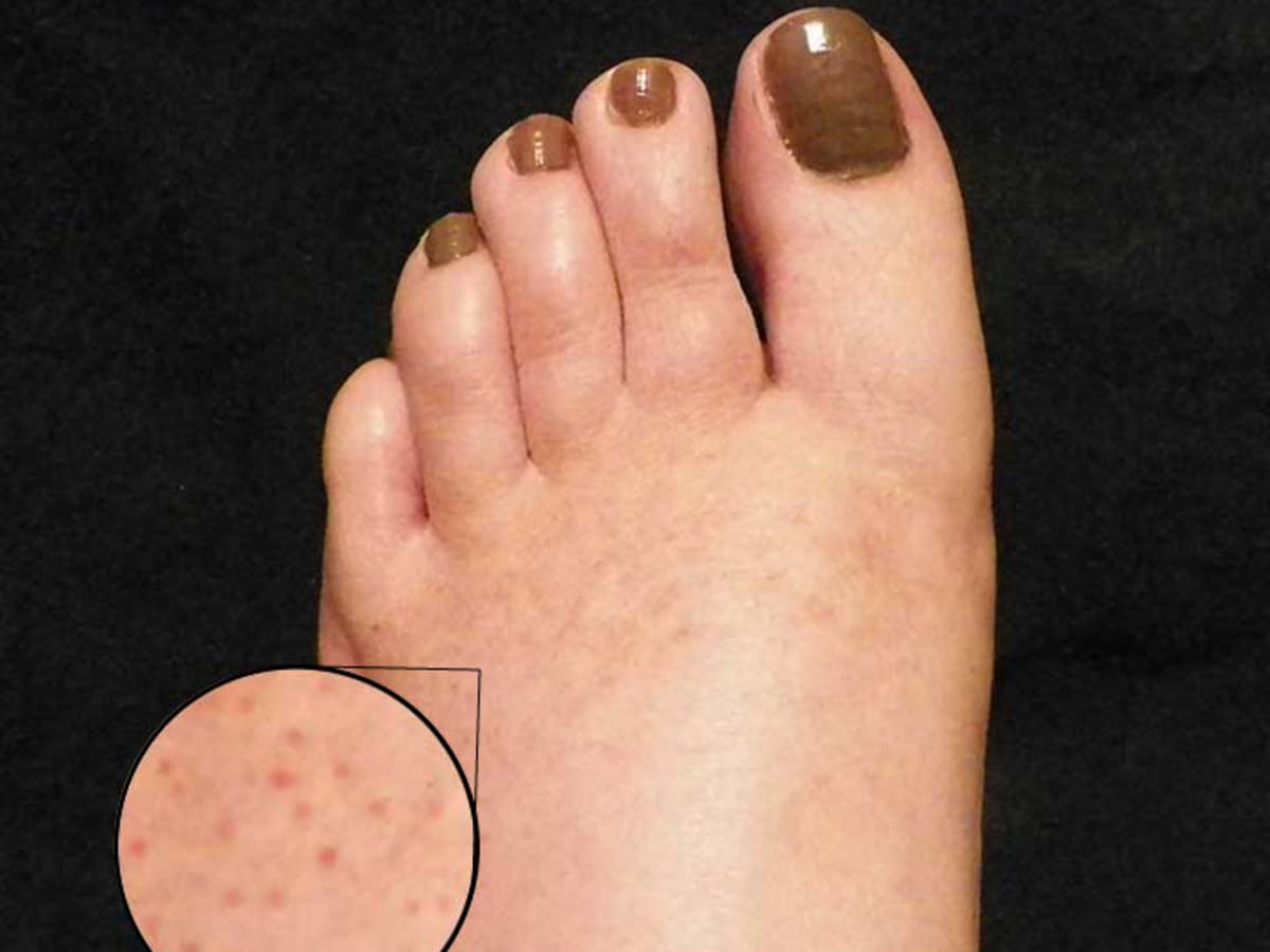 Causes Of Red Dots On Feet 