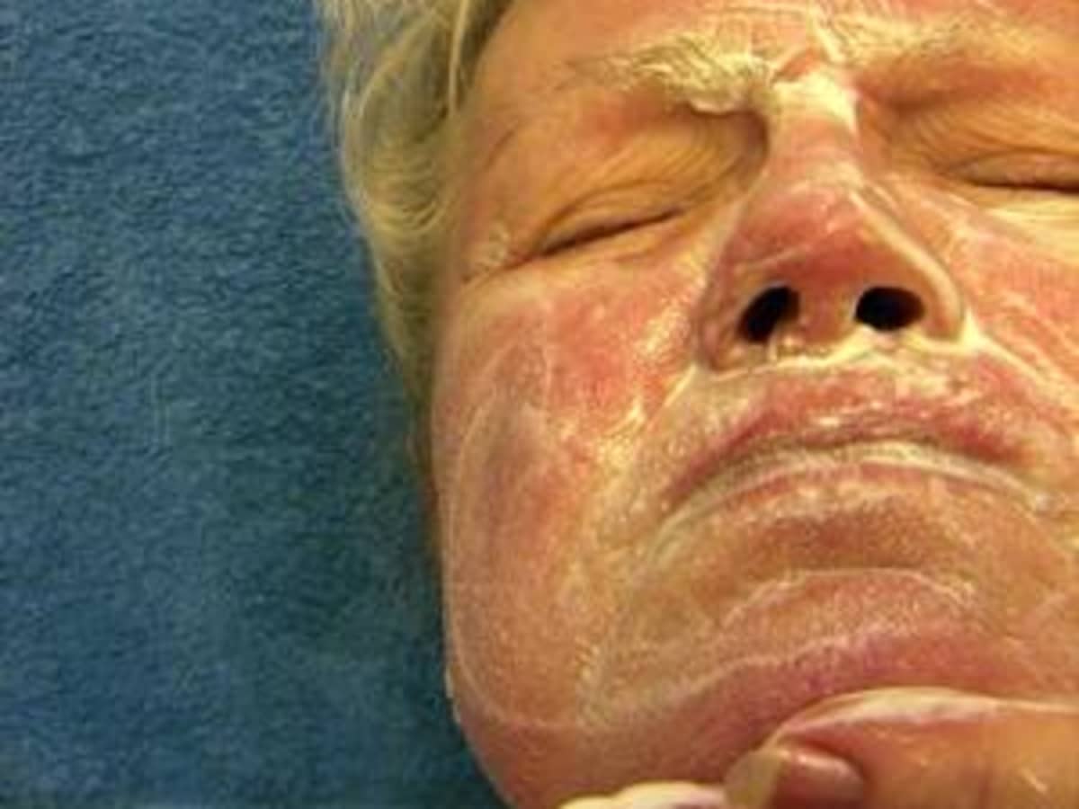 The Dangers In Using Sulphur Cream Hubpages