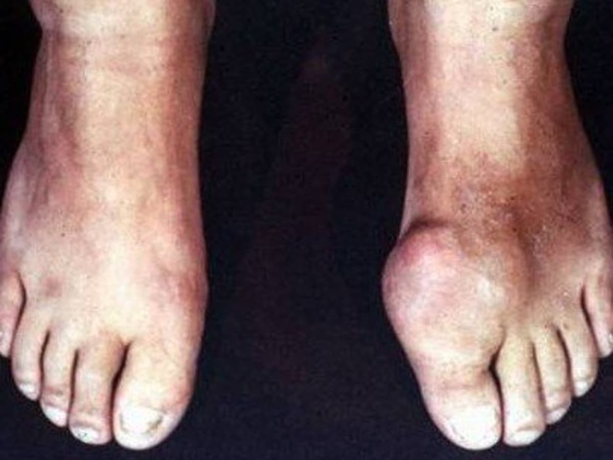 gout and alcohol symptoms treatment and home remedies hubpages