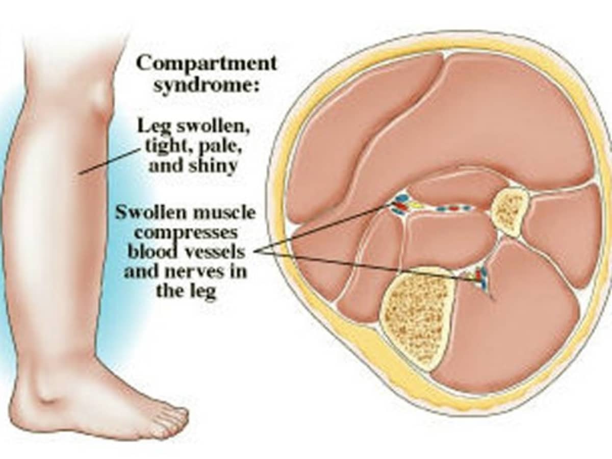 Compartment Syndrome - Pictures, Treatment, Causes, Surgery - HubPages
