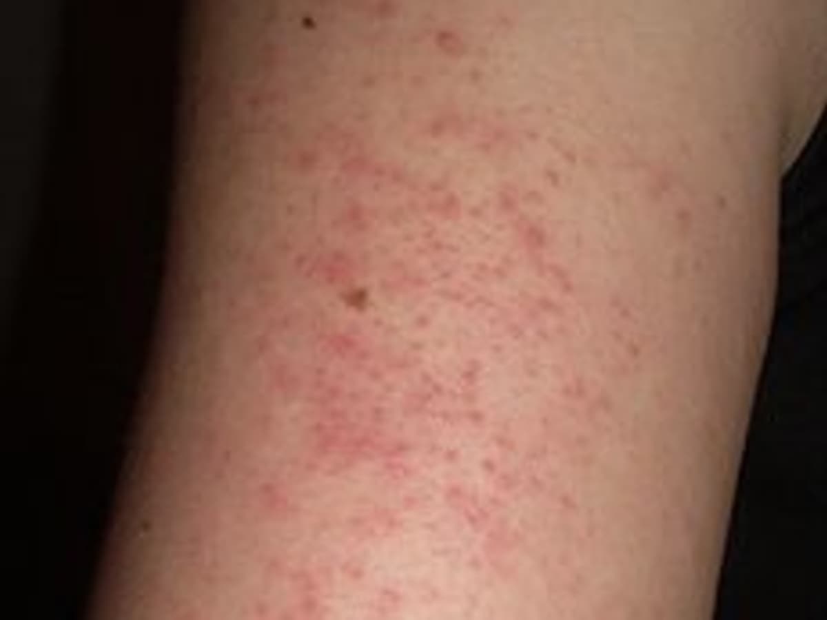 Red Spots on Skin - HubPages