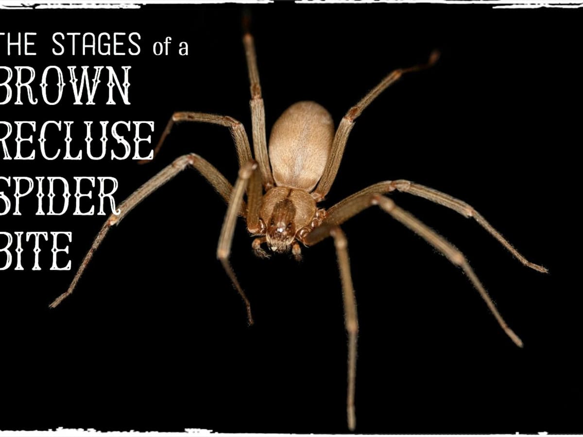 pix Picture Of Brown Recluse Spider Bite Stages brown recluse bite pictures stages