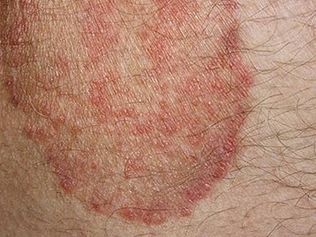 Dermatophyte Infection: What Is It, Causes, Signs and Symptoms, Diagnosis,  Treatment, and More | Osmosis
