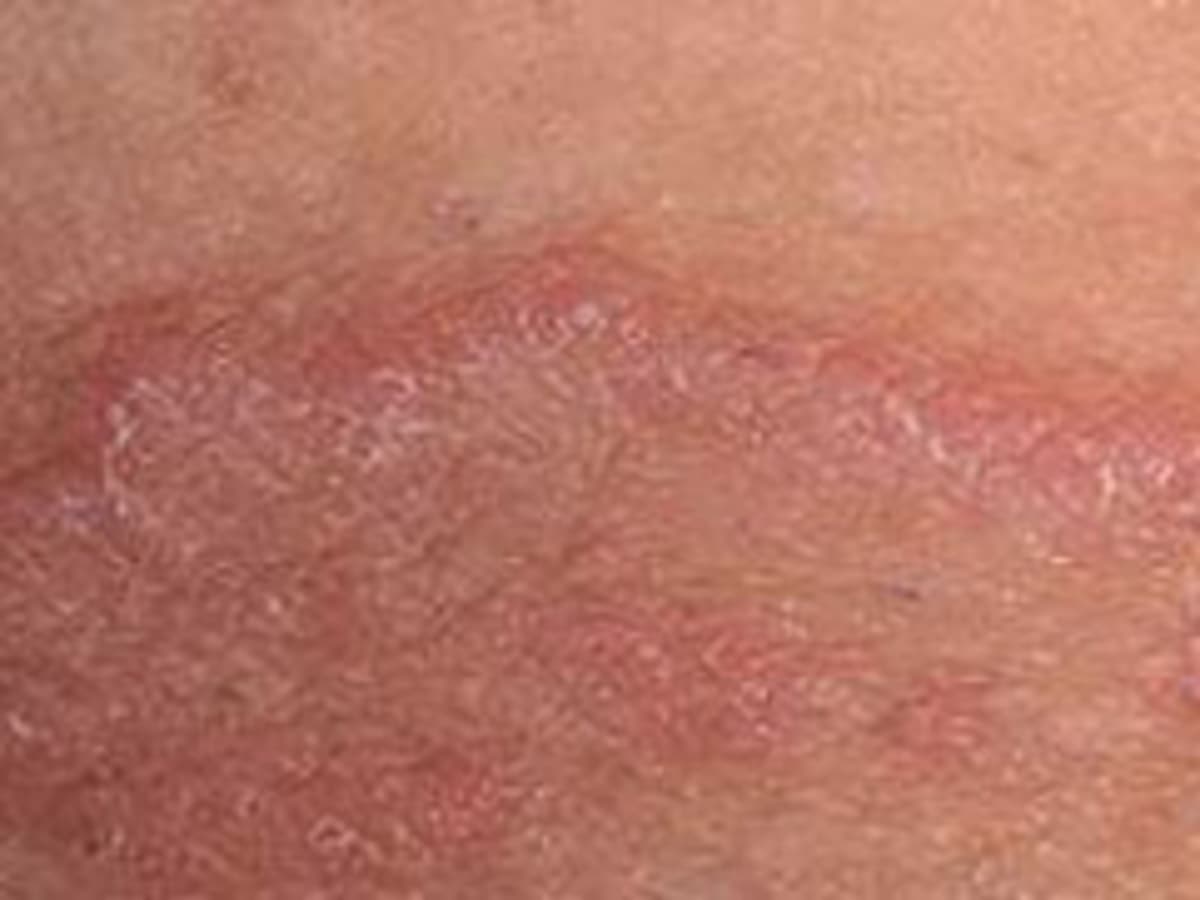 What Jock Itch, and What to Do about that Red, Itchy Penile Skin - HubPages