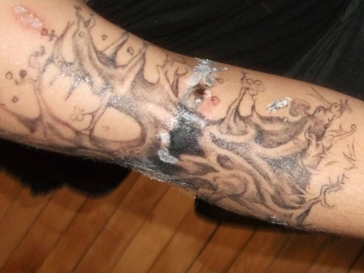 DIY Home Tattoo Removal is Dangerous  Removery