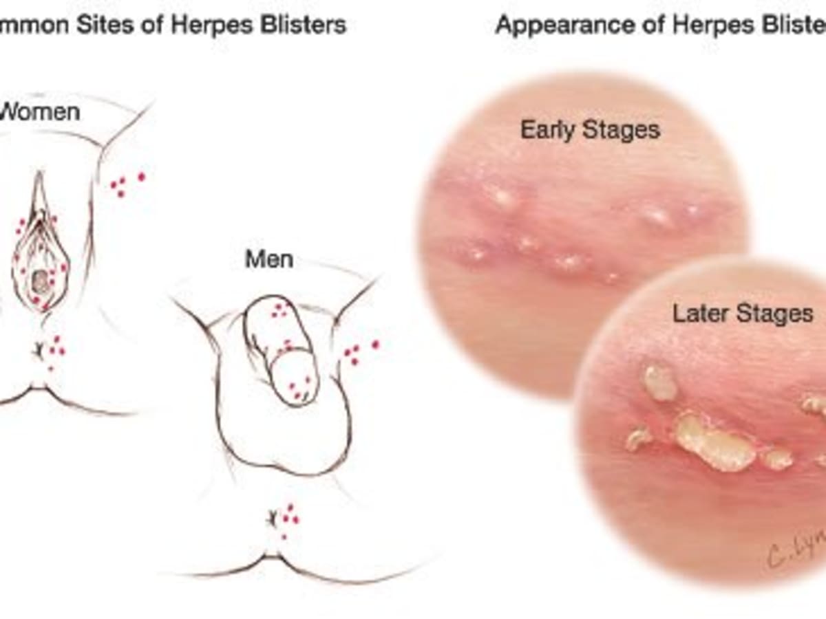 What Are The Symptoms Of A First Herpes Outbreak Hubpages