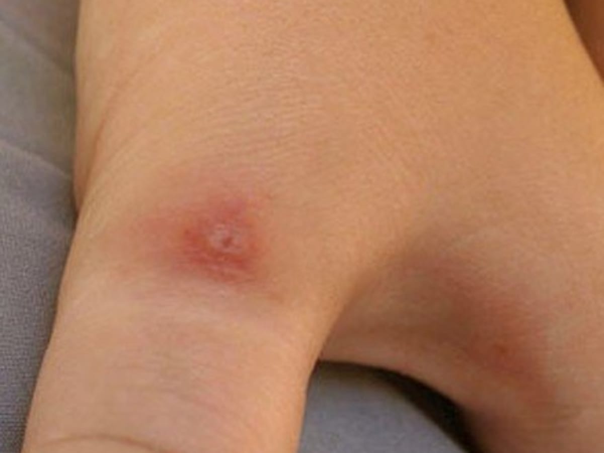 Pictures Symptoms And Treatment Of Black Widow Spider Bites Hubpages
