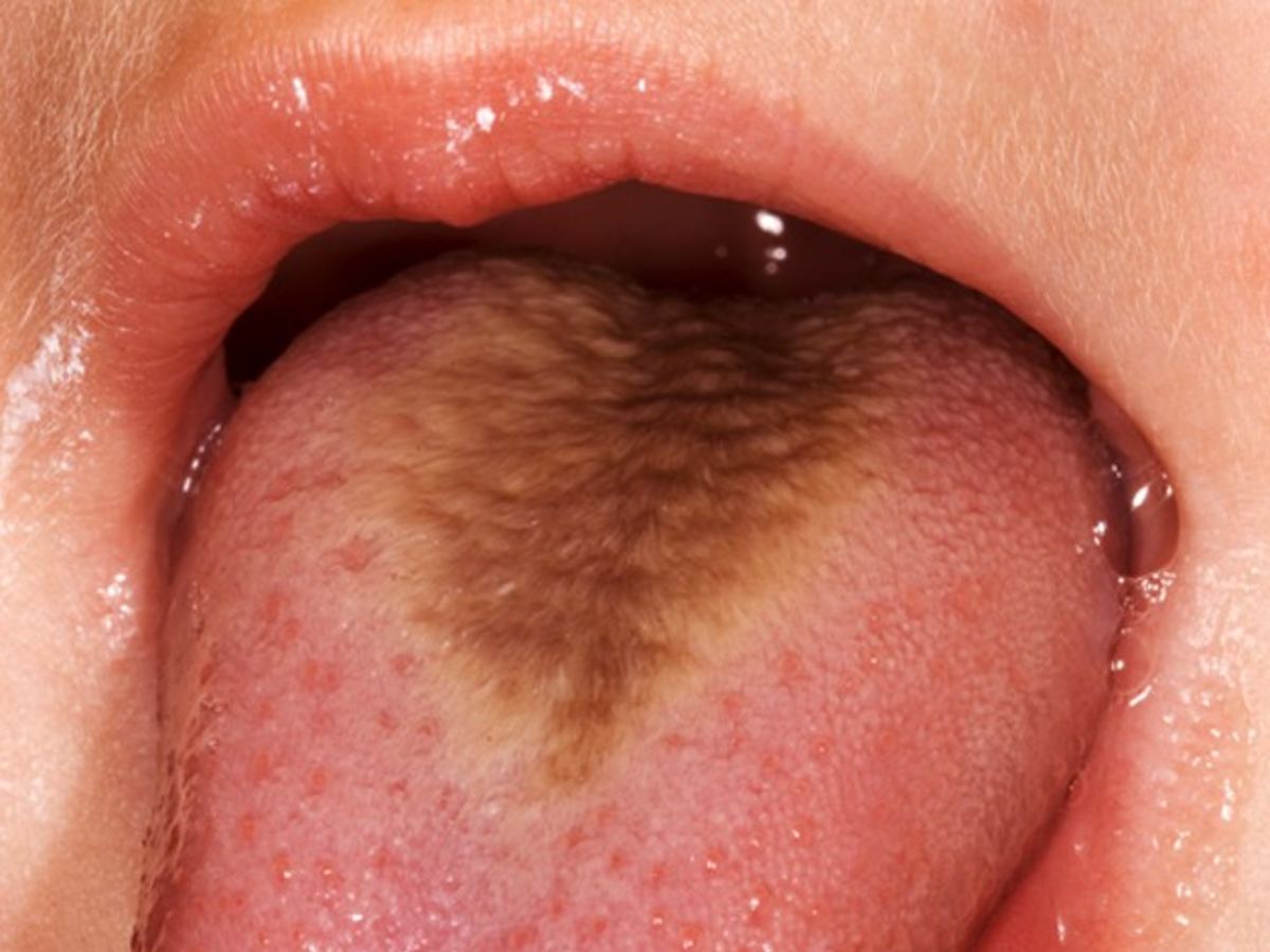 hairy tongue from smoking cigarettes Poster Smoker Gets Green & Hairy