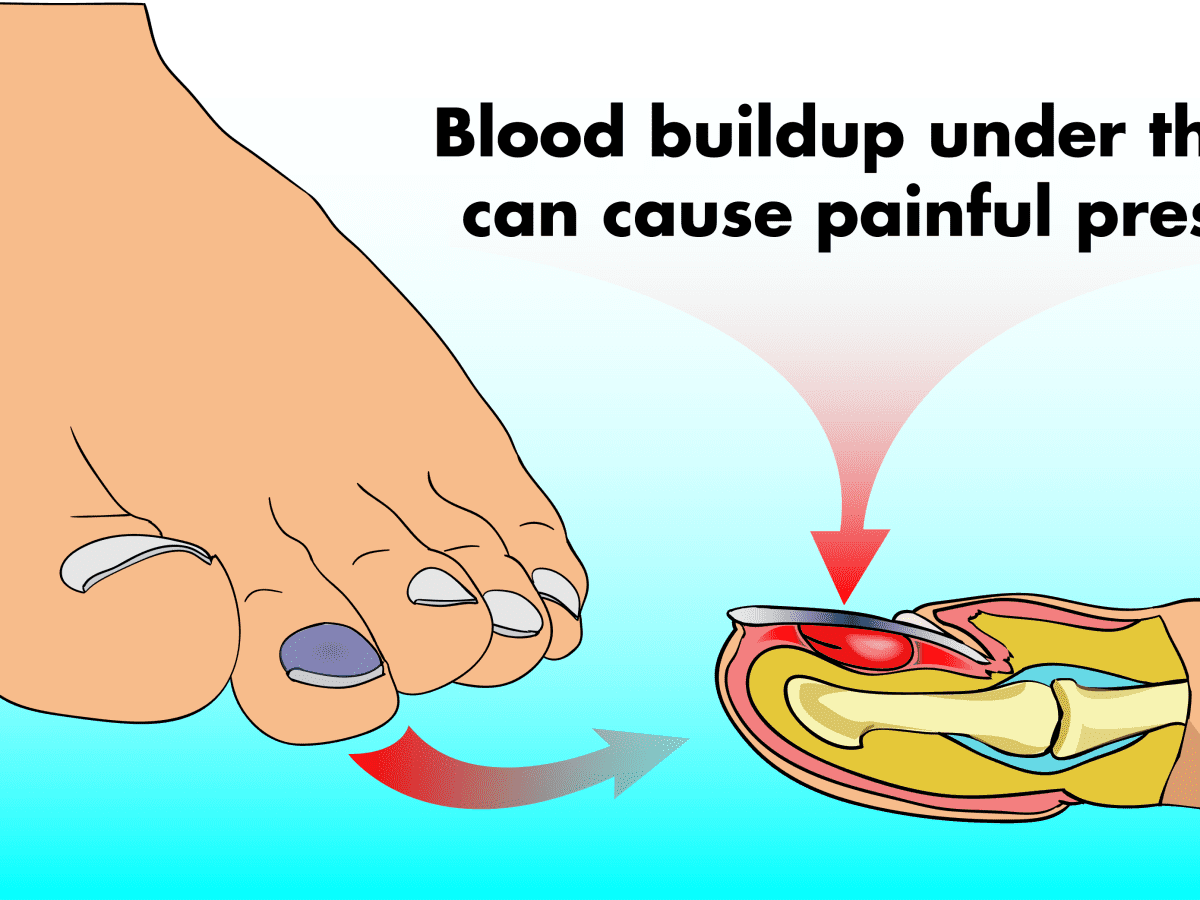 How to Treat a Blood Blister Under the Nail - YouMeMindBody