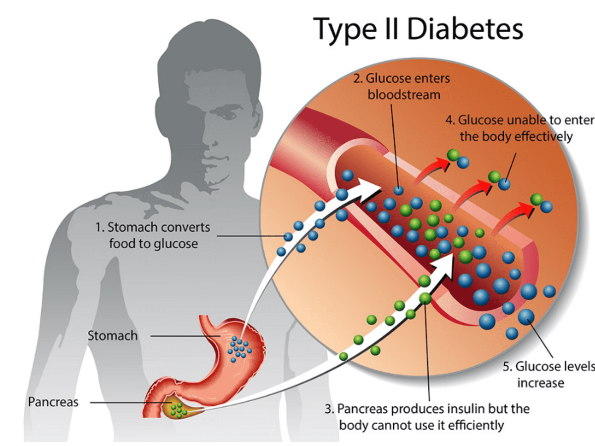 Isogei Technology and Type 2 Diabetes - Electrical Muscle