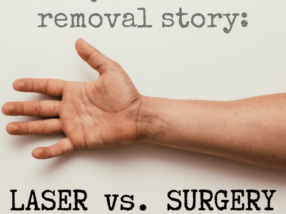 My Experience With Surgical Excision and Laser Tattoo Removal Procedures -  TatRing