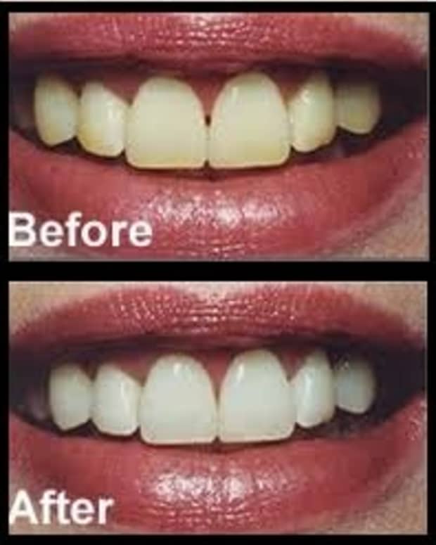homemade-teeth-whitening