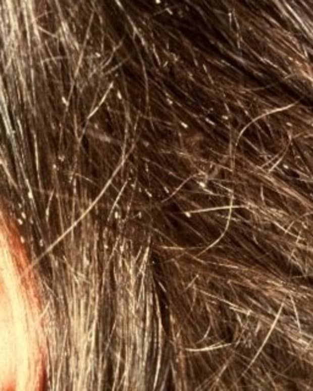Close up of nits in a girl's hair