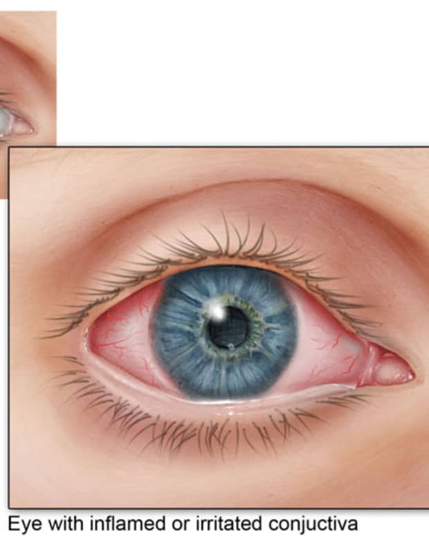 what-to-do-for-pink-eye