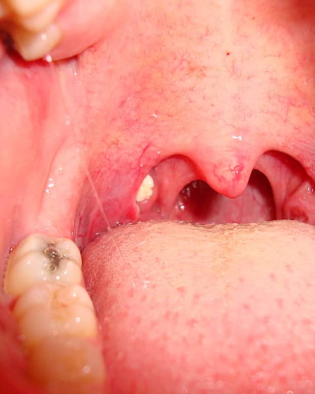 pictures-of-white-bumps-in-throat
