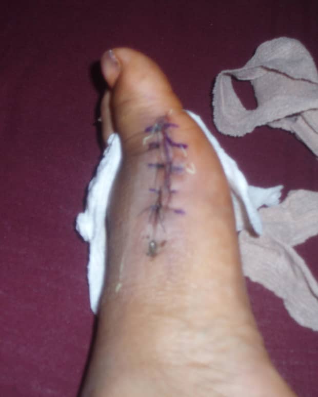my-bunion-surgery-after-6-months-of-recovery