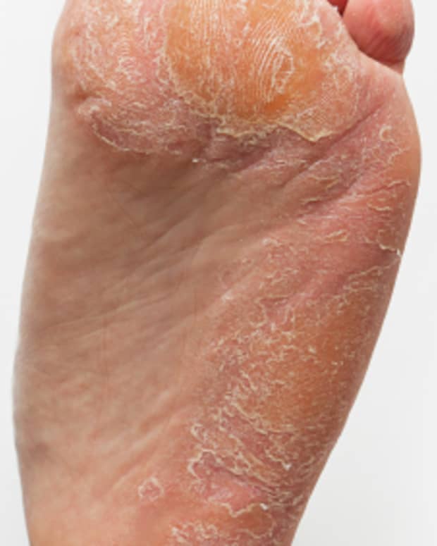 tips-for-the-successful-removal-of-corns-on-feet