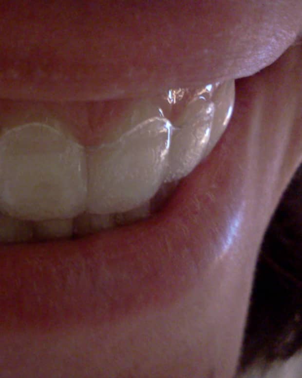 how-to-prevent-cavaties-with-invisalign