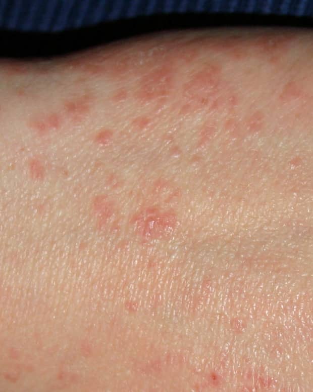 scabies-can-cause-itching-and-crawling-sensations-on-your-skin