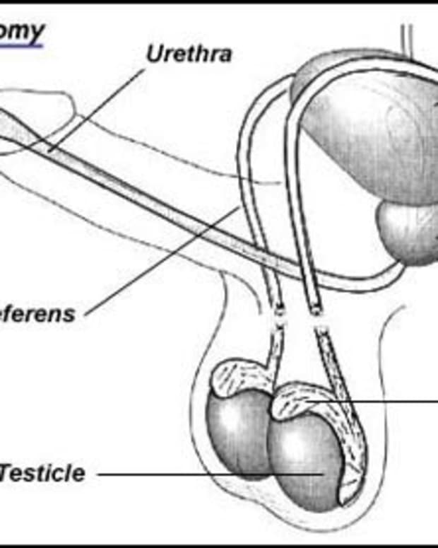 vasectomy-what-to-expect