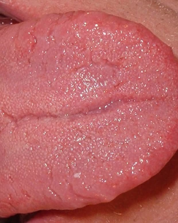 swollen-tongue-a-painful-and-possibly-dangerous-health-disorder