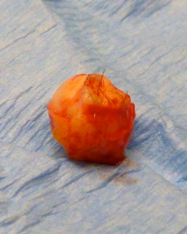 this-is-what-a-cyst-looks-like