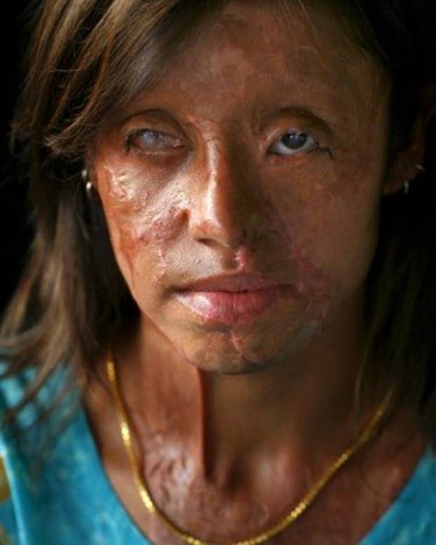 acid-attacks-on-women-and-how-you-can-help