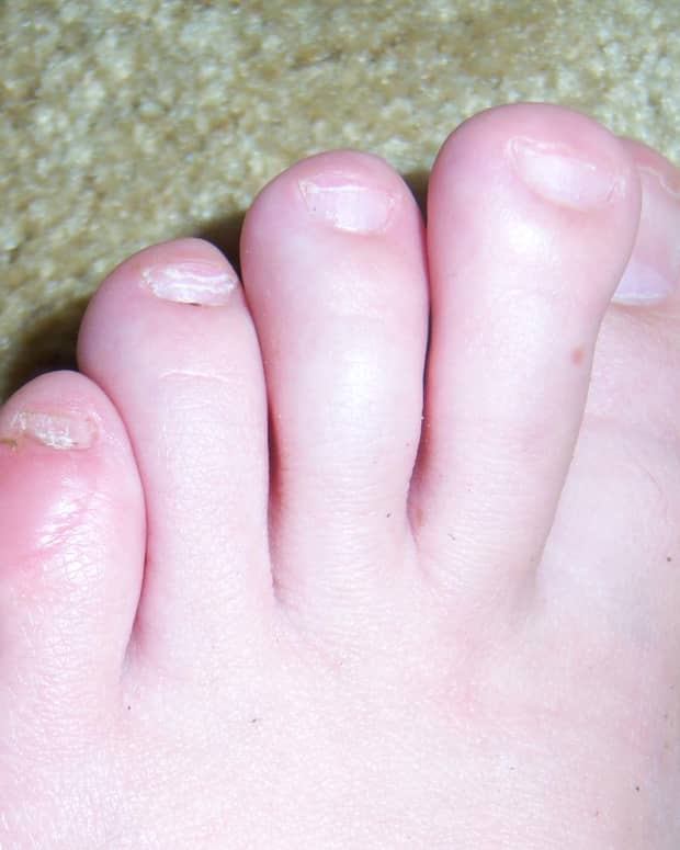 how-to-care-for-a-foot-blister