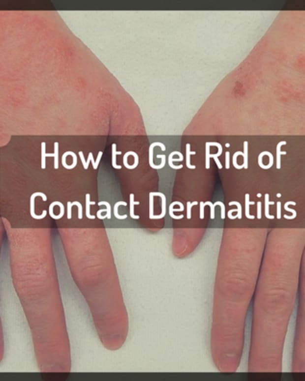 getting-rid-of-itchy-contact-dermatitis-the-natural-way-without-prescription-drugs