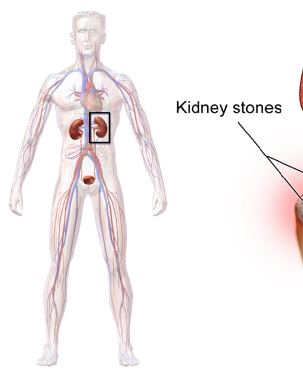 how-to-prevent-loosing-your-kidney-due-to-stones-my-true-story