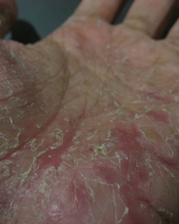 how-i-treated-my-pompholyx-eczema-dyshidrotic-dermatitis-skin-condition