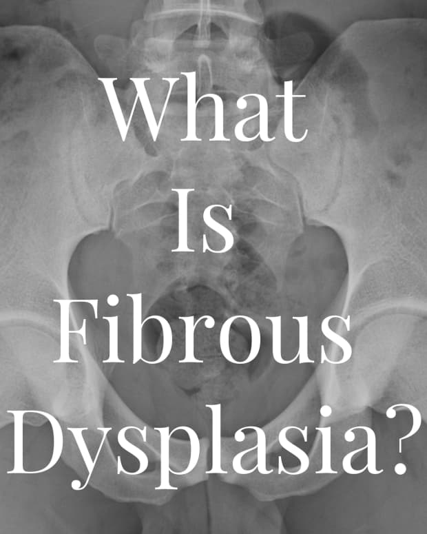 the-debilitating-curse-of-fibrous-dysplasia