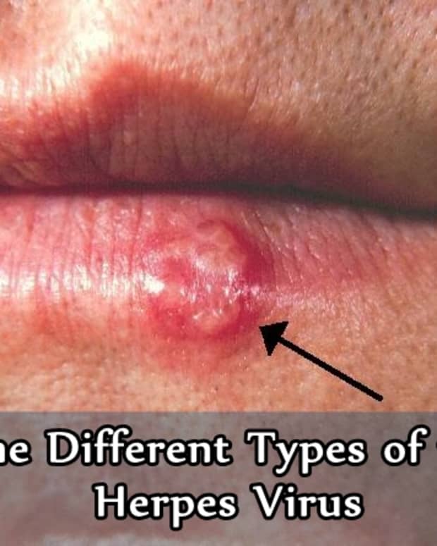 the-different-types-of-the-herpes-virus