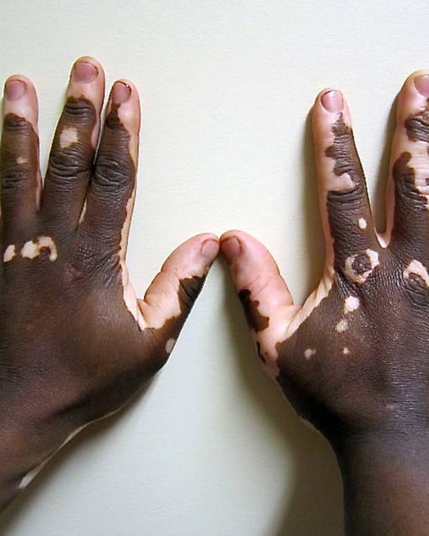 vitiligo-a-skin-disorder-with-loss-of-pigmentation