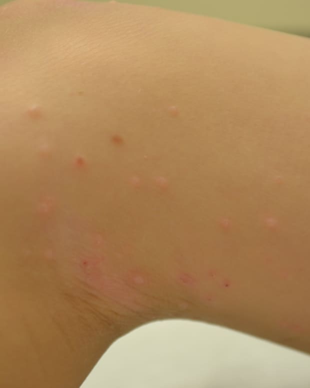 what-is-molluscum-contagiosum-and-how-to-treat-it