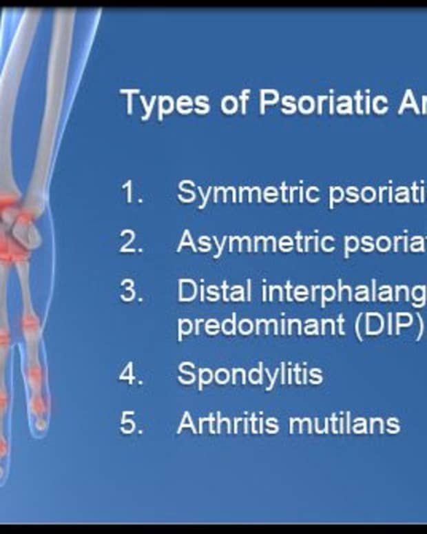 psoriatic-arthritis-arthritis-symptoms-and-arthritis-treatment