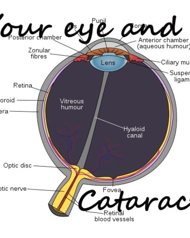 eyes-and-cataracts