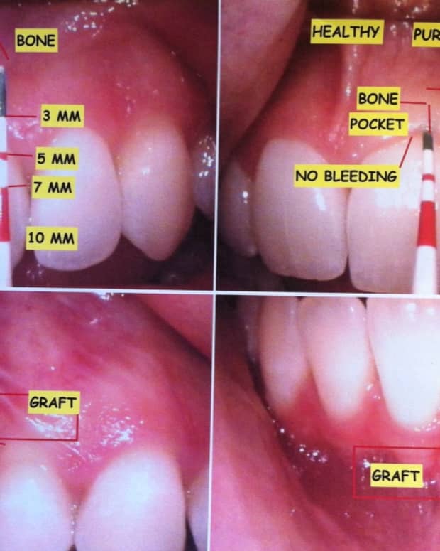 what-its-like-to-get-gum-grafting-surgery