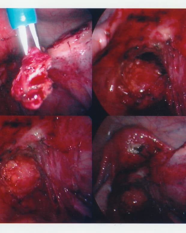 Removing severe endometriosis during a laparoscopy.