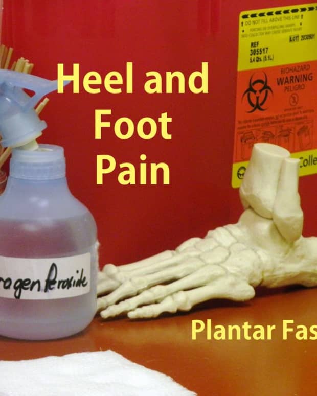 treatment-for-plantar-fasciitis-foot-pain