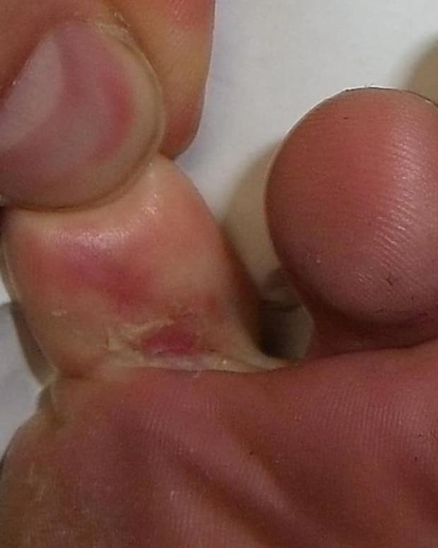 how-to-cure-foot-fungus