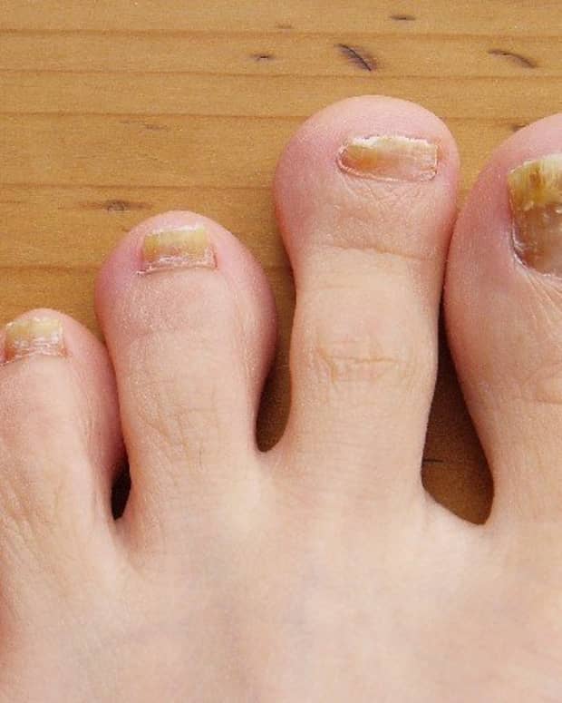 nail-fungal-infection